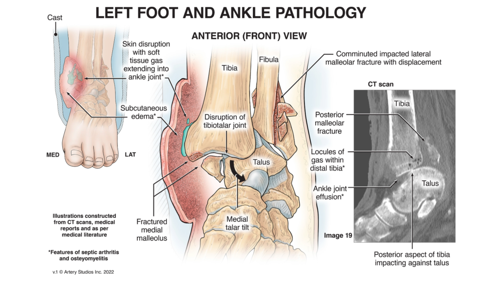 Left foot and ankle pathology concept illustration