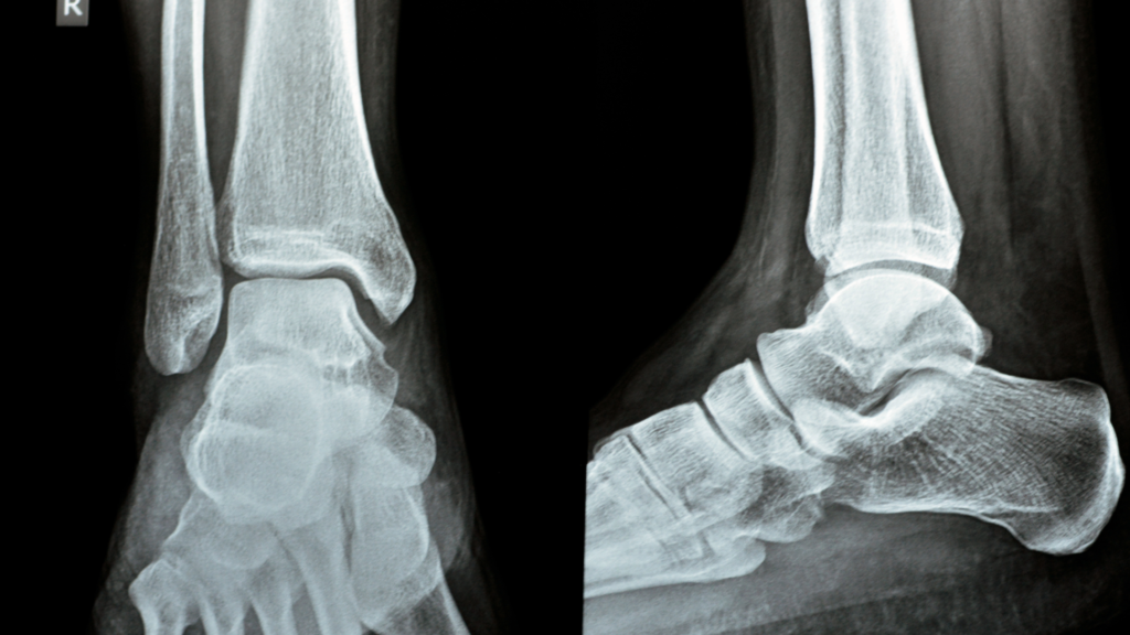 X-ray depicting an ankle fracture