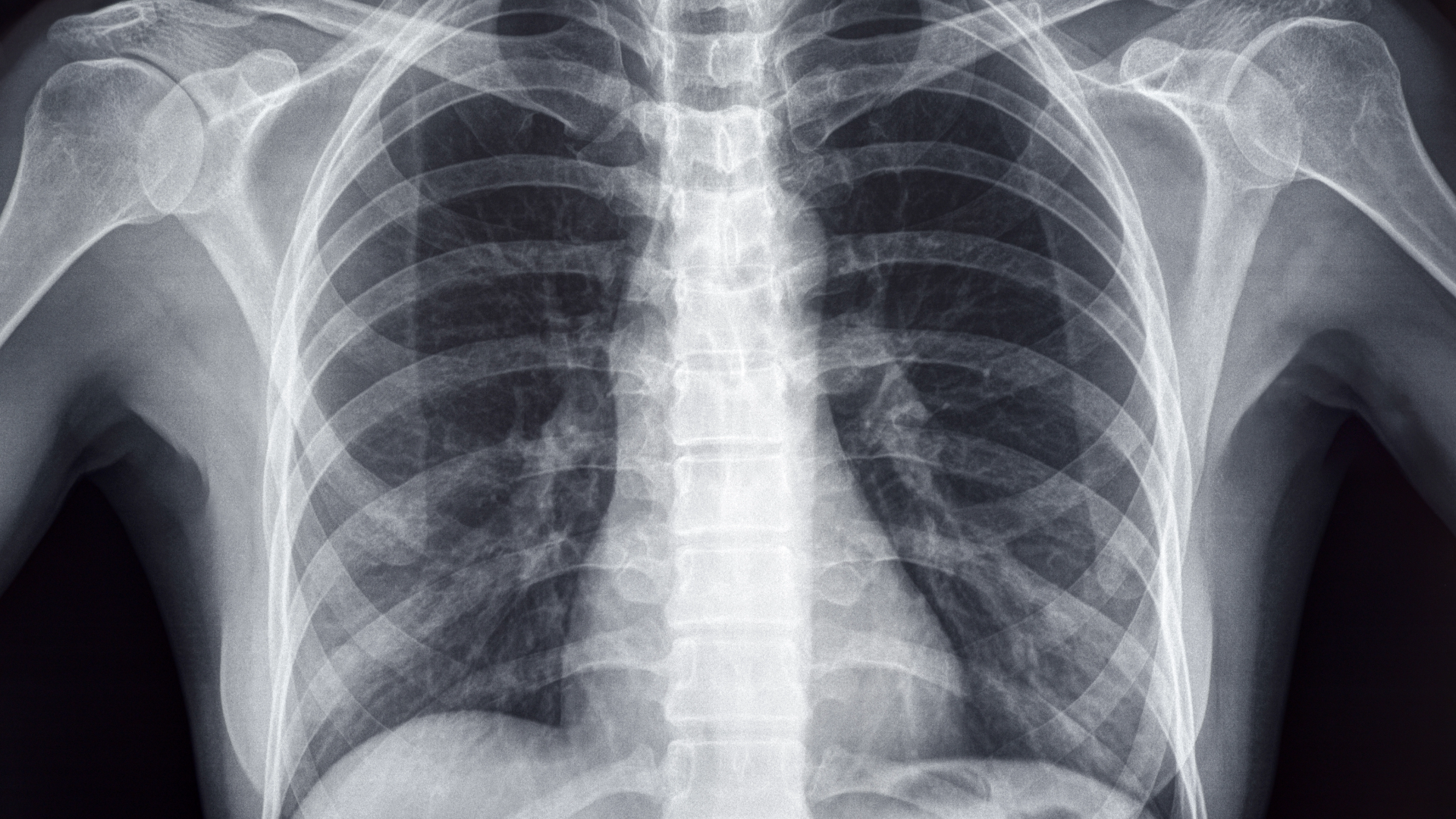 X-ray of chest