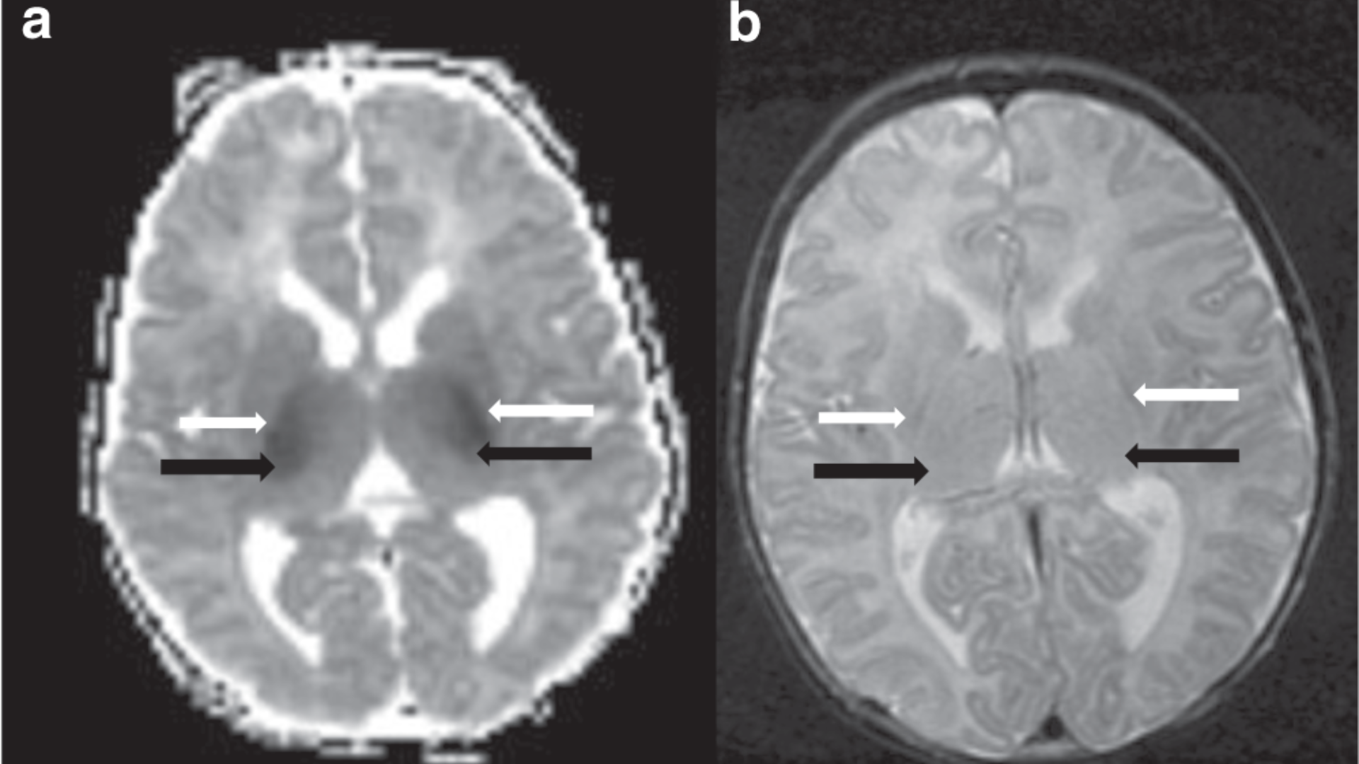 CT of a baby's brain