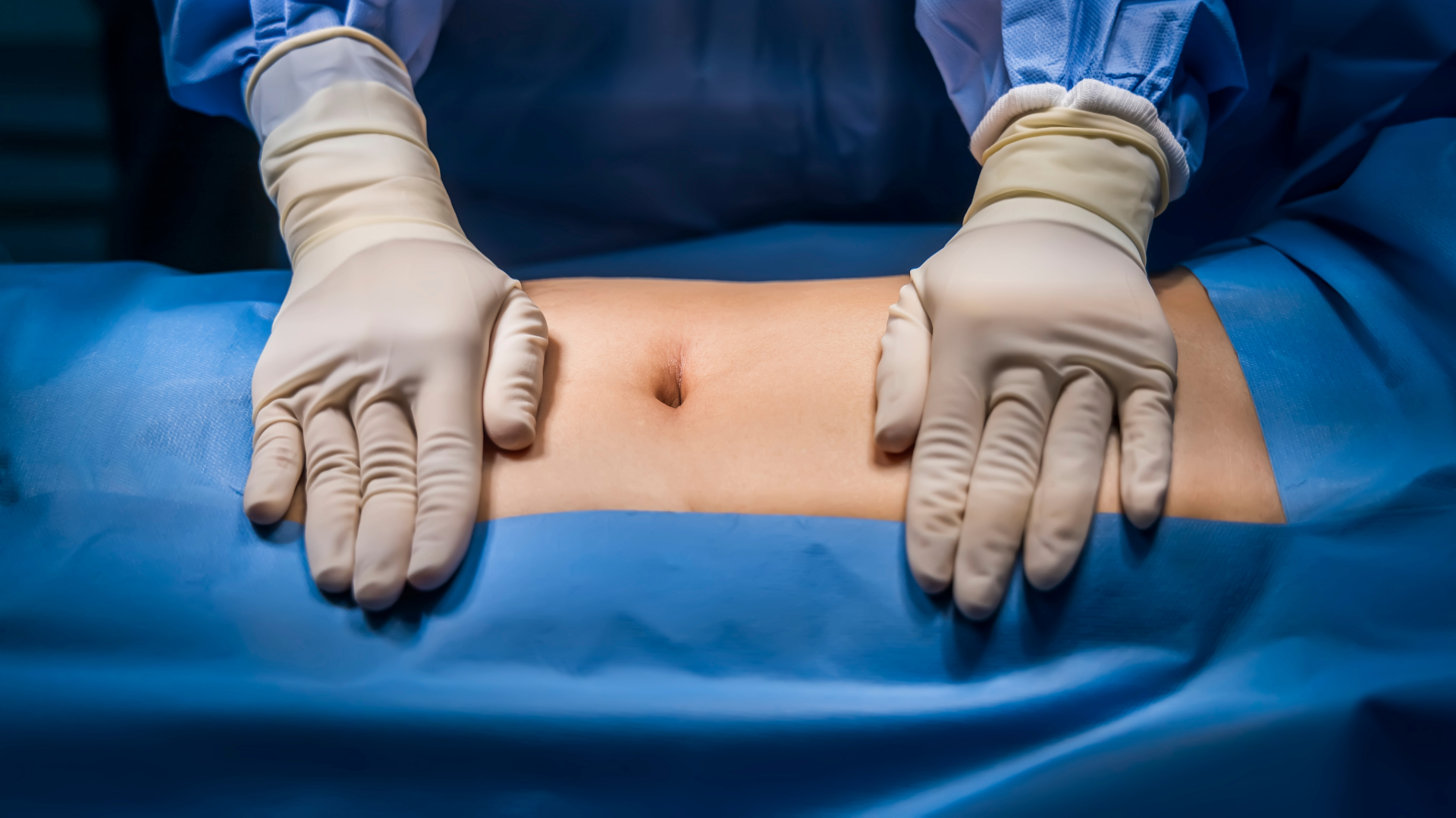 A photograph of an abdomen in an operating room