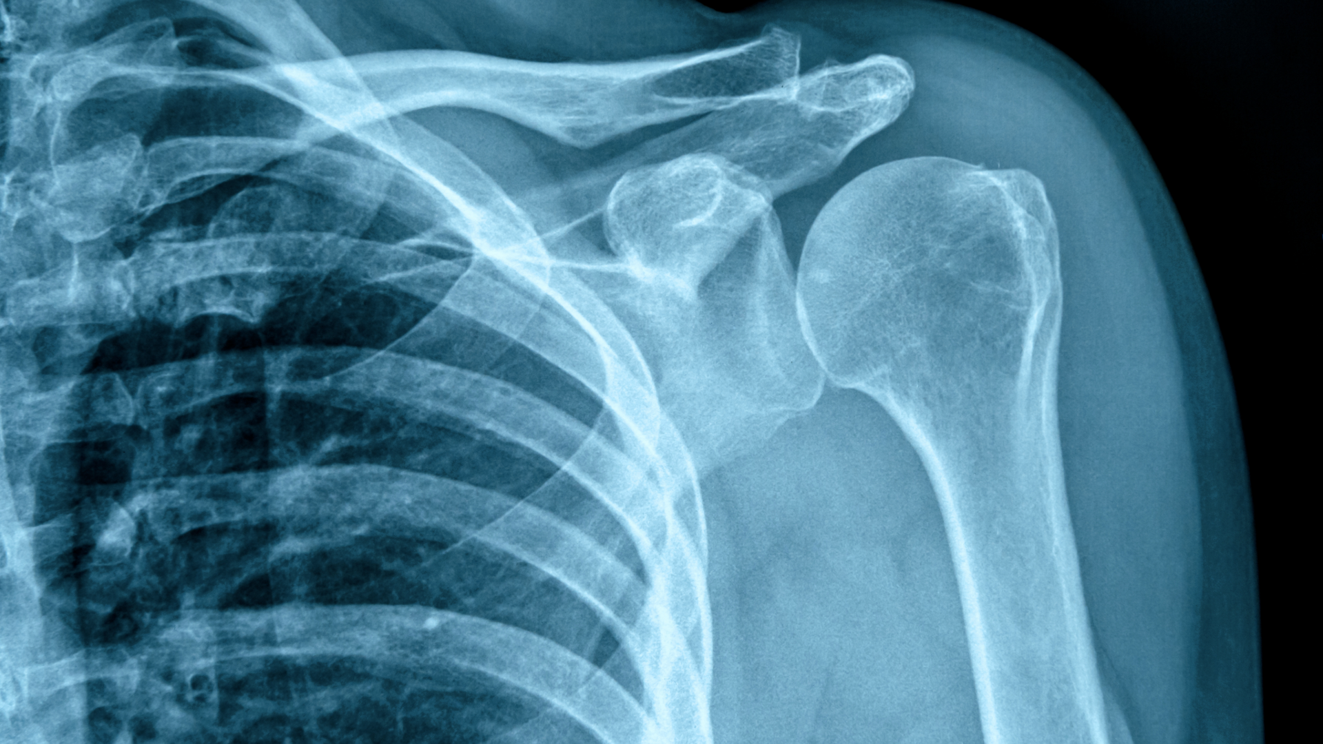 An x-ray of a person's clavicle area.