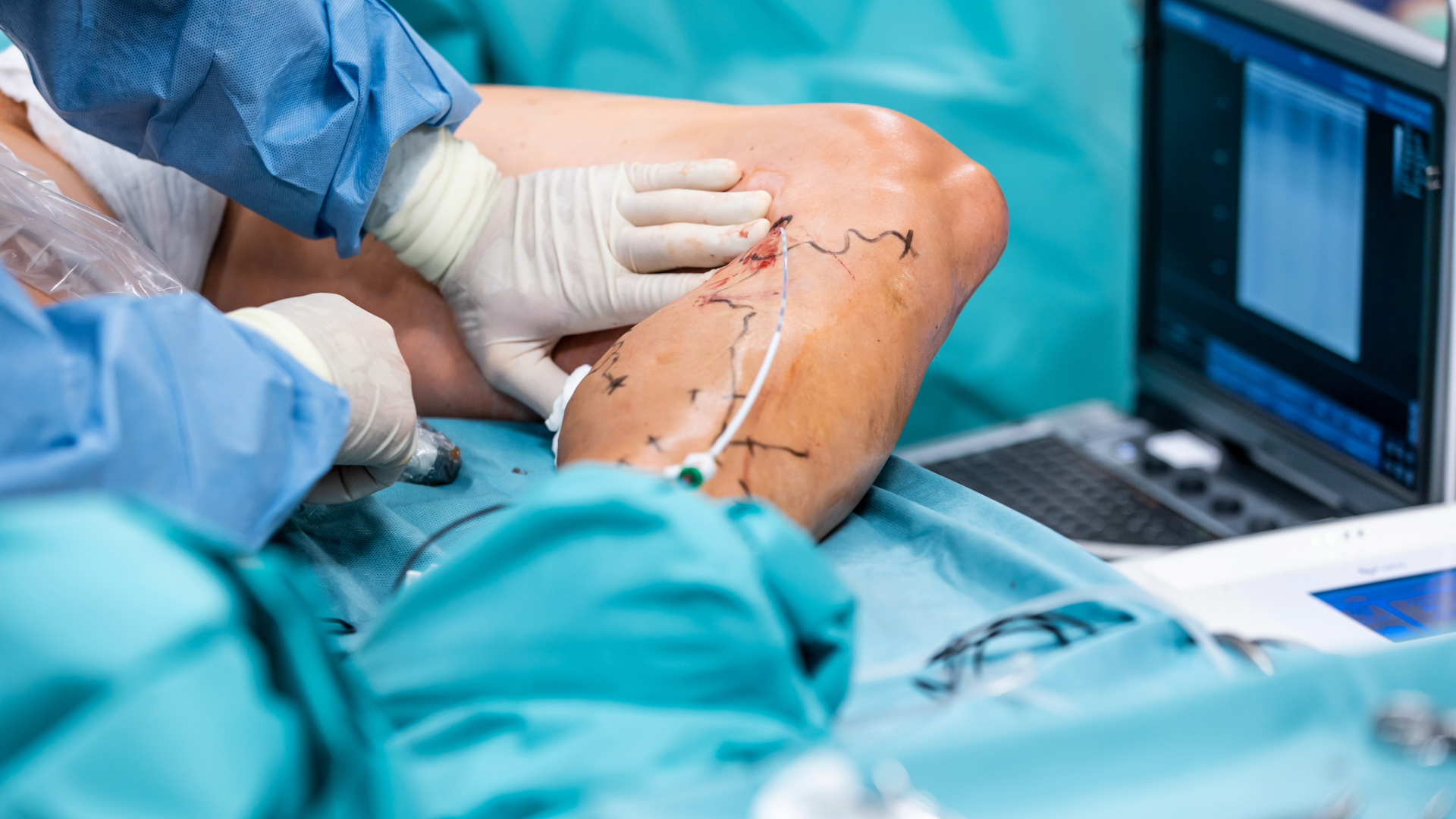 A personal undergoing a vascular surgical procedure.