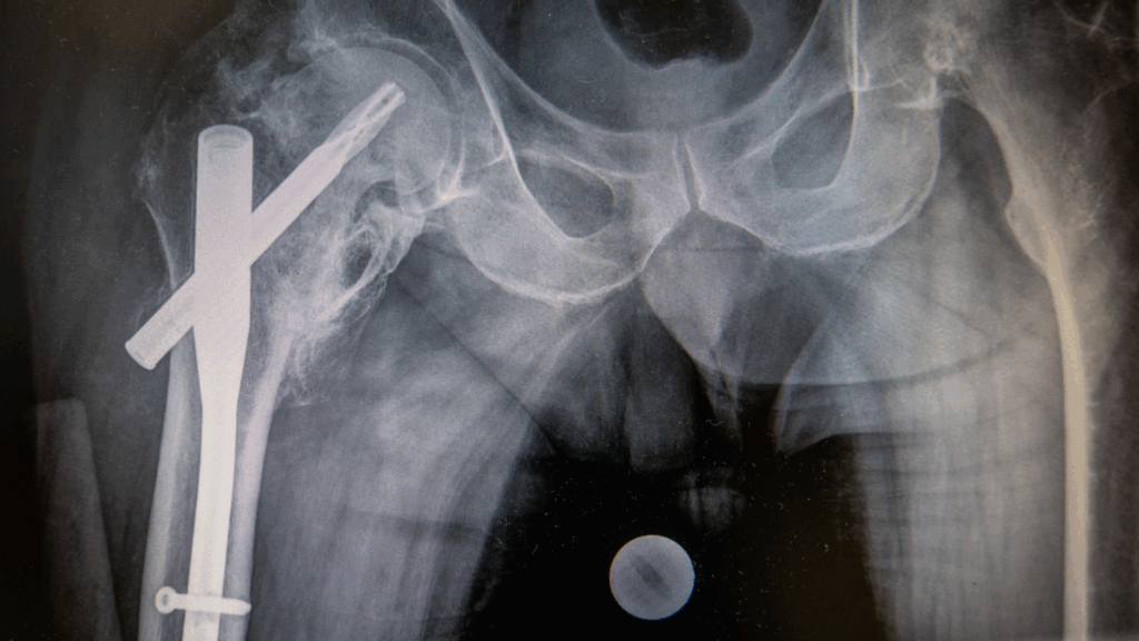 X-ray of a Hip Fracture