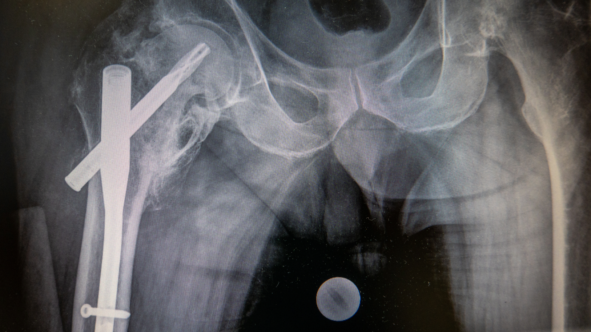 X-ray of a Hip Fracture