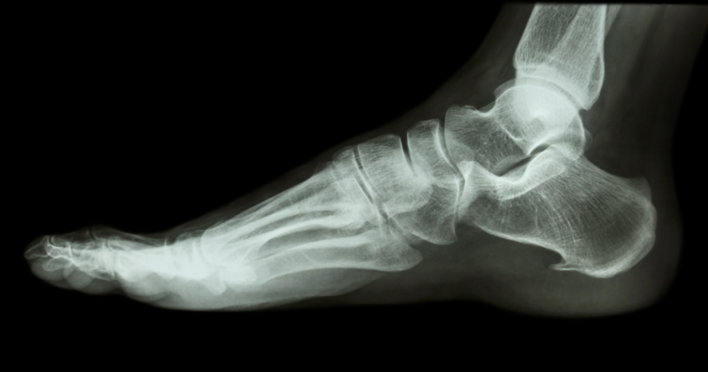 Operating on an Anticoagulated Patient: A Difficult Ankle Surgery and a Permanent Disability | Paul Cahill Medical Malpractice Lawyer Lateral X-ray of a foot showing the ankle and heel bones (calcaneus).